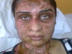 Bo�anmak �steyen E�inin Y�z�ne Kezzap Att�